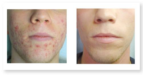 trattamento cicatrici acne